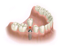 Implanturile cu un singur dinte